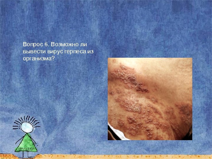 Вопрос 6. Возможно ли вывести вирус герпеса из организма? 