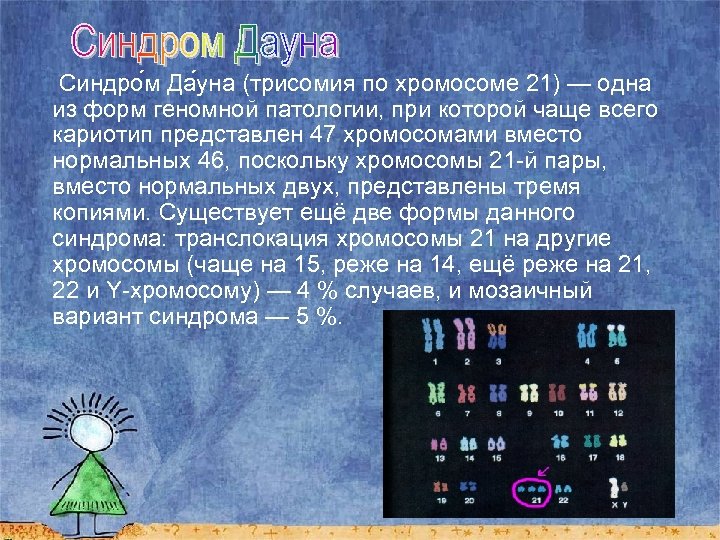  Синдро м Да уна (трисомия по хромосоме 21) — одна из форм геномной