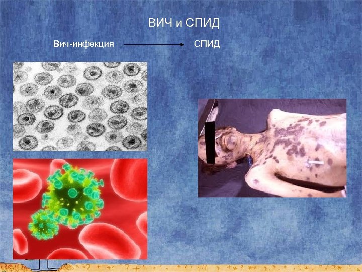 ВИЧ и СПИД Вич-инфекция СПИД 