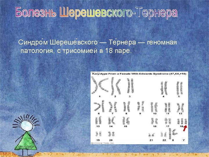  Синдро м Шереше вского — Те рнера — геномная патология, с трисомией в