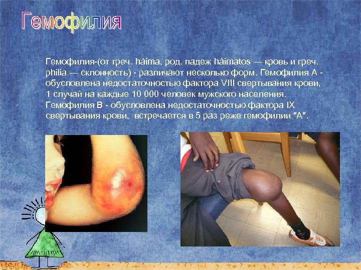 Гемофилия-(от греч. háima, род. падеж háimatos — кровь и греч. philia — склонность) -
