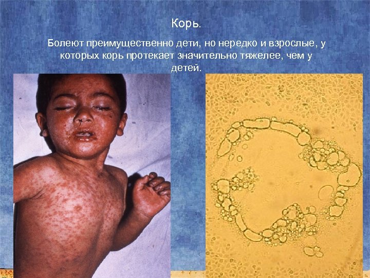 Корь. Болеют преимущественно дети, но нередко и взрослые, у которых корь протекает значительно тяжелее,