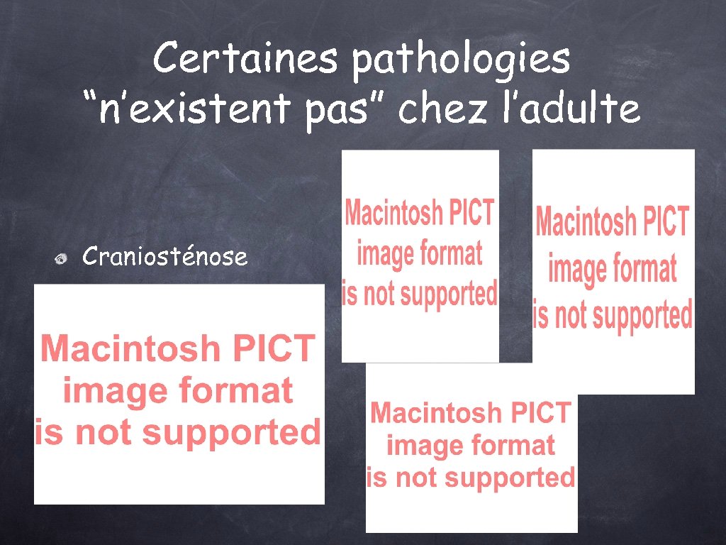 Certaines pathologies “n’existent pas” chez l’adulte Craniosténose Malformation de la veine de Galien Pathologie