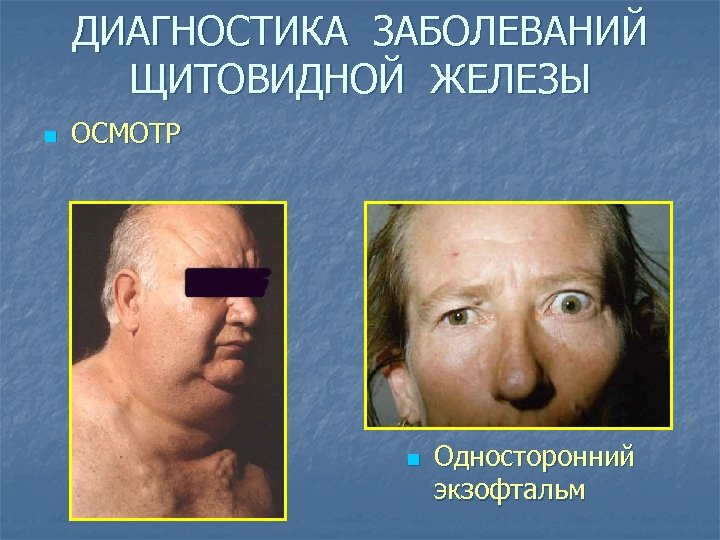 ДИАГНОСТИКА ЗАБОЛЕВАНИЙ ЩИТОВИДНОЙ ЖЕЛЕЗЫ n ОСМОТР n Односторонний экзофтальм 