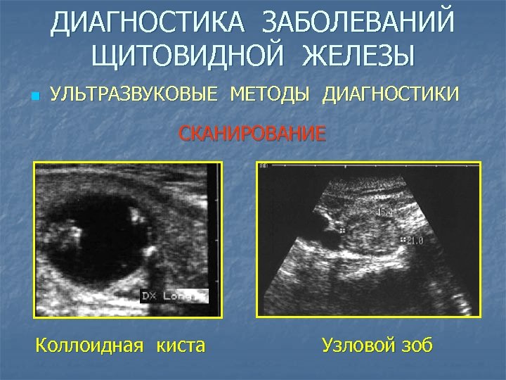 ДИАГНОСТИКА ЗАБОЛЕВАНИЙ ЩИТОВИДНОЙ ЖЕЛЕЗЫ n УЛЬТРАЗВУКОВЫЕ МЕТОДЫ ДИАГНОСТИКИ СКАНИРОВАНИЕ Коллоидная киста Узловой зоб 