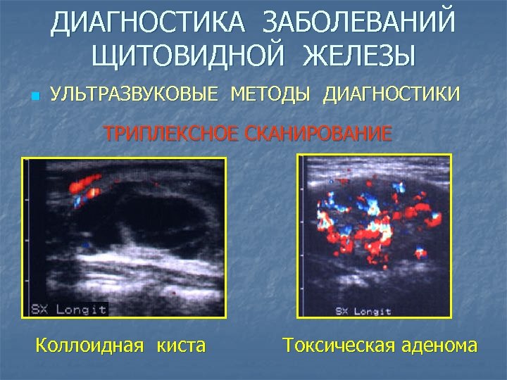 ДИАГНОСТИКА ЗАБОЛЕВАНИЙ ЩИТОВИДНОЙ ЖЕЛЕЗЫ n УЛЬТРАЗВУКОВЫЕ МЕТОДЫ ДИАГНОСТИКИ ТРИПЛЕКСНОЕ СКАНИРОВАНИЕ Коллоидная киста Токсическая аденома