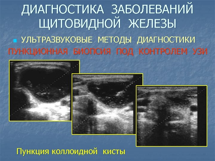 ДИАГНОСТИКА ЗАБОЛЕВАНИЙ ЩИТОВИДНОЙ ЖЕЛЕЗЫ УЛЬТРАЗВУКОВЫЕ МЕТОДЫ ДИАГНОСТИКИ ПУНКЦИОННАЯ БИОПСИЯ ПОД КОНТРОЛЕМ УЗИ n Пункция