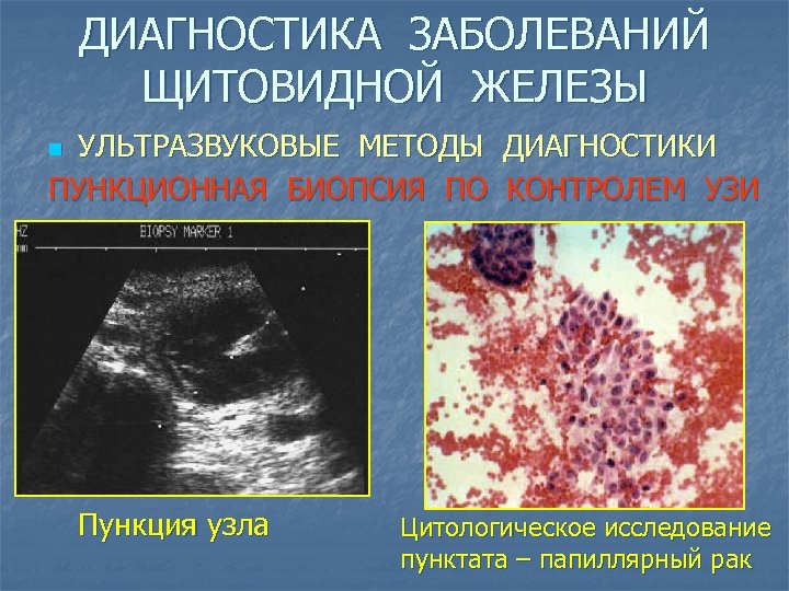 ДИАГНОСТИКА ЗАБОЛЕВАНИЙ ЩИТОВИДНОЙ ЖЕЛЕЗЫ УЛЬТРАЗВУКОВЫЕ МЕТОДЫ ДИАГНОСТИКИ ПУНКЦИОННАЯ БИОПСИЯ ПО КОНТРОЛЕМ УЗИ n Пункция