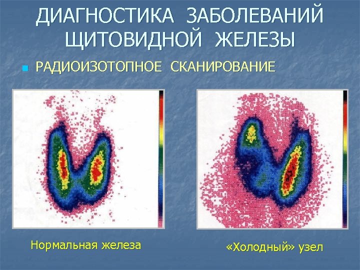 ДИАГНОСТИКА ЗАБОЛЕВАНИЙ ЩИТОВИДНОЙ ЖЕЛЕЗЫ n РАДИОИЗОТОПНОЕ СКАНИРОВАНИЕ Нормальная железа «Холодный» узел 