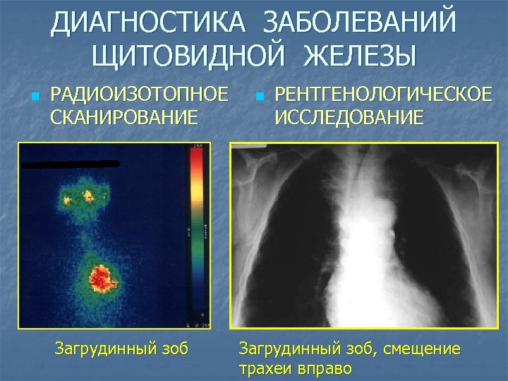 ДИАГНОСТИКА ЗАБОЛЕВАНИЙ ЩИТОВИДНОЙ ЖЕЛЕЗЫ n РАДИОИЗОТОПНОЕ СКАНИРОВАНИЕ Загрудинный зоб n РЕНТГЕНОЛОГИЧЕСКОЕ ИССЛЕДОВАНИЕ Загрудинный зоб,