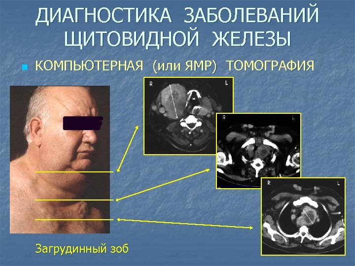 ДИАГНОСТИКА ЗАБОЛЕВАНИЙ ЩИТОВИДНОЙ ЖЕЛЕЗЫ n КОМПЬЮТЕРНАЯ (или ЯМР) ТОМОГРАФИЯ Загрудинный зоб 