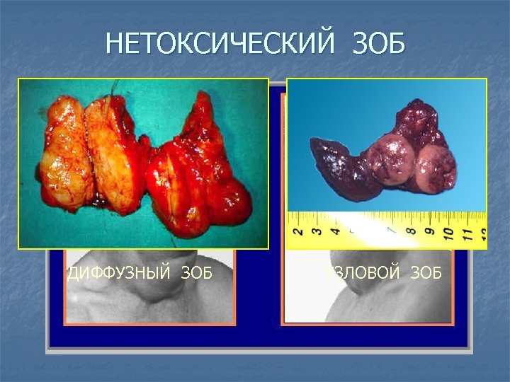 НЕТОКСИЧЕСКИЙ ЗОБ ДИФФУЗНЫЙ ЗОБ УЗЛОВОЙ ЗОБ 