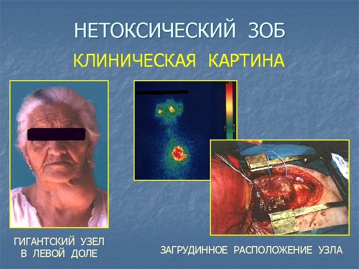 НЕТОКСИЧЕСКИЙ ЗОБ КЛИНИЧЕСКАЯ КАРТИНА ГИГАНТСКИЙ УЗЕЛ В ЛЕВОЙ ДОЛЕ ЗАГРУДИННОЕ РАСПОЛОЖЕНИЕ УЗЛА 