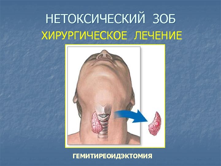 НЕТОКСИЧЕСКИЙ ЗОБ ХИРУРГИЧЕСКОЕ ЛЕЧЕНИЕ ГЕМИТИРЕОИДЭКТОМИЯ 