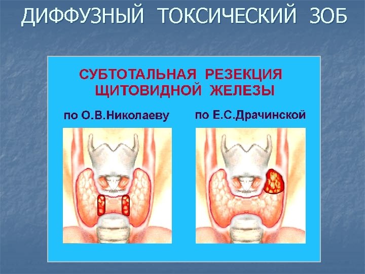 ДИФФУЗНЫЙ ТОКСИЧЕСКИЙ ЗОБ 