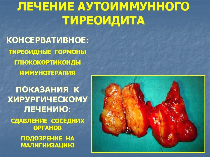 ЛЕЧЕНИЕ АУТОИММУННОГО ТИРЕОИДИТА КОНСЕРВАТИВНОЕ: ТИРЕОИДНЫЕ ГОРМОНЫ ГЛЮКОКОРТИКОИДЫ ИММУНОТЕРАПИЯ ПОКАЗАНИЯ К ХИРУРГИЧЕСКОМУ ЛЕЧЕНИЮ: СДАВЛЕНИЕ СОСЕДНИХ