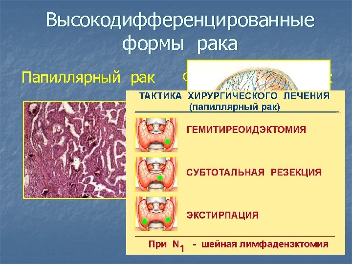 Высокодифференцированные формы рака Папиллярный рак Фолликулярный рак 