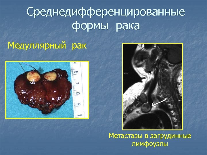 Среднедифференцированные формы рака Медуллярный рак Метастазы в загрудинные лимфоузлы 