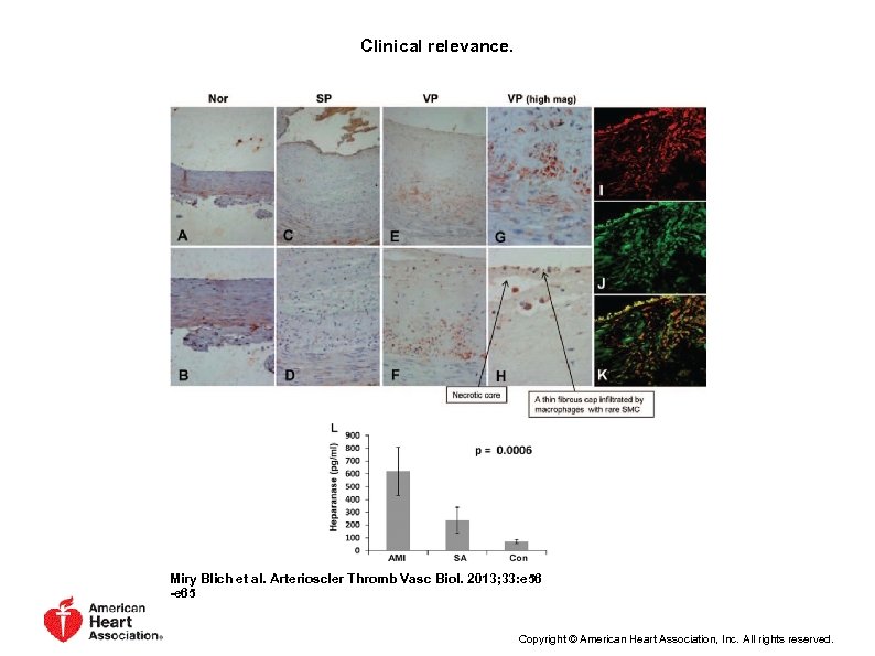 Clinical relevance. Miry Blich et al. Arterioscler Thromb Vasc Biol. 2013; 33: e 56