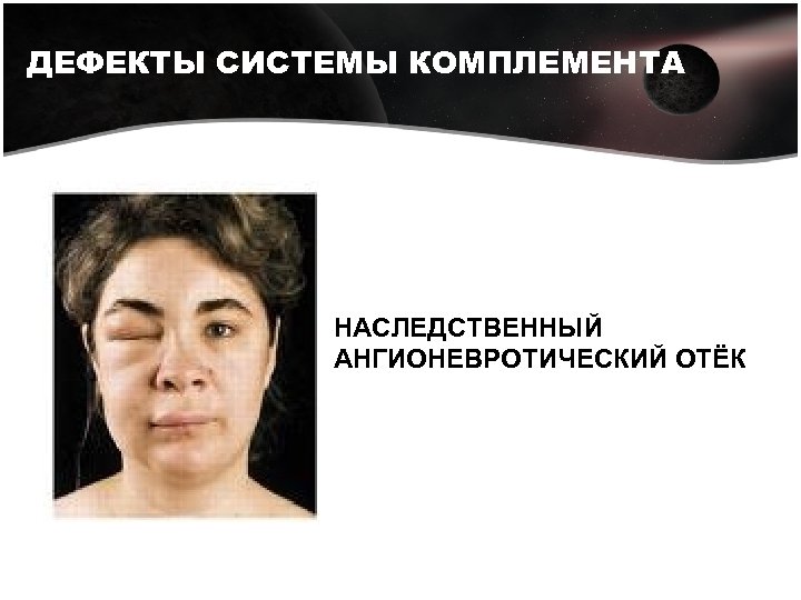ДЕФЕКТЫ СИСТЕМЫ КОМПЛЕМЕНТА НАСЛЕДСТВЕННЫЙ АНГИОНЕВРОТИЧЕСКИЙ ОТЁК 