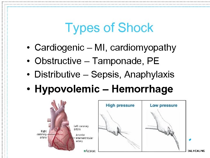 Types of Shock • Cardiogenic – MI, cardiomyopathy • Obstructive – Tamponade, PE •