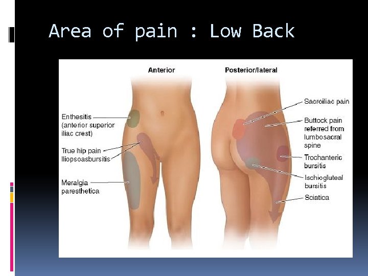 Area of pain : Low Back 