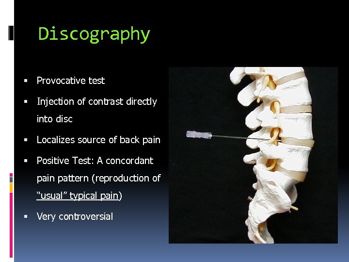 Discography Provocative test Injection of contrast directly into disc Localizes source of back pain