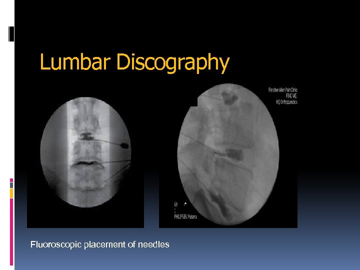 Lumbar Discography Fluoroscopic placement of needles 