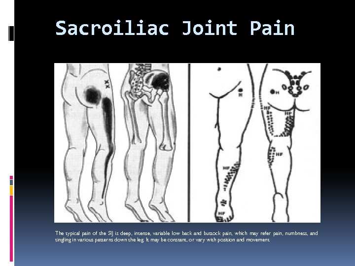 Sacroiliac Joint Pain The typical pain of the SIJ is deep, intense, variable low