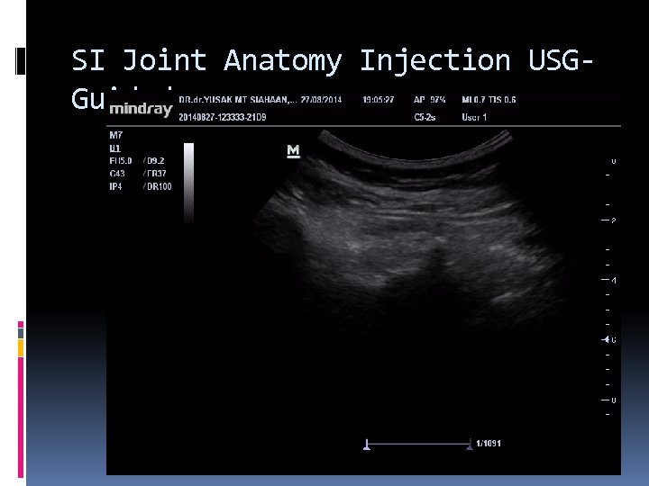 SI Joint Anatomy Injection USGGuided 