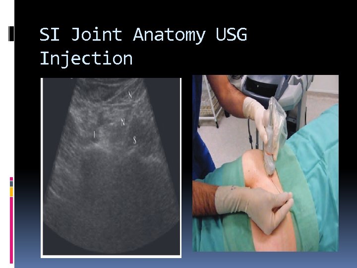 SI Joint Anatomy USG Injection 