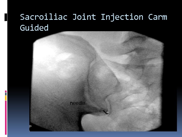 Sacroiliac Joint Injection Carm Guided needle 
