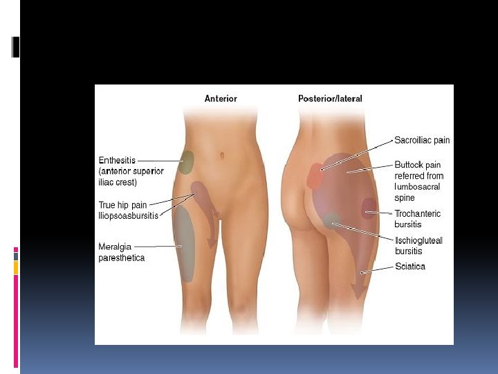 Piriformis Syndrome Pain 