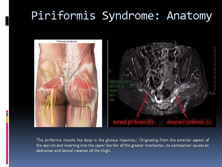 Piriformis Syndrome: Anatomy The piriformis muscle lies deep in the gluteus maximus. 1 Originating