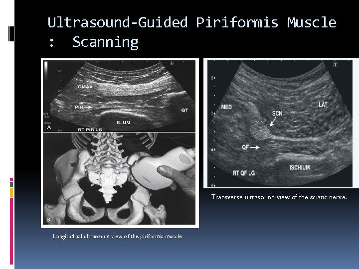 Ultrasound-Guided Piriformis Muscle : Scanning Transverse ultrasound view of the sciatic nerve. Longitudinal ultrasound