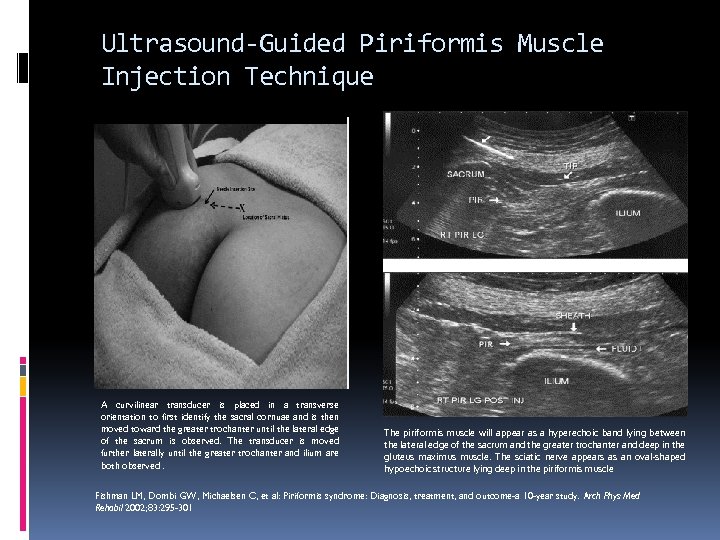 Ultrasound-Guided Piriformis Muscle Injection Technique A curvilinear transducer is placed in a transverse orientation