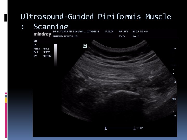 Ultrasound-Guided Piriformis Muscle : Scanning 