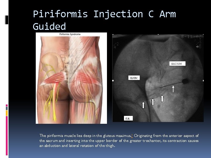 Piriformis Injection C Arm Guided The piriformis muscle lies deep in the gluteus maximus.