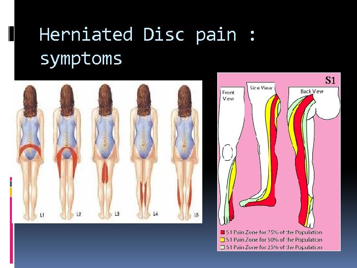 Herniated Disc pain : symptoms 