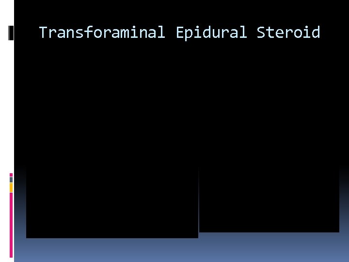 Transforaminal Epidural Steroid 