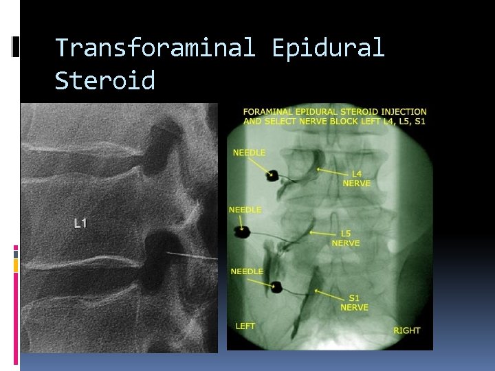 Transforaminal Epidural Steroid 