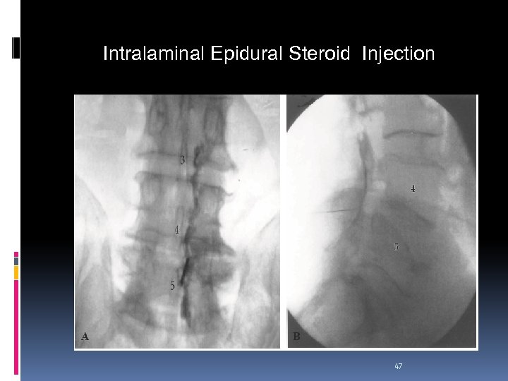 Intralaminal Epidural Steroid Injection 47 