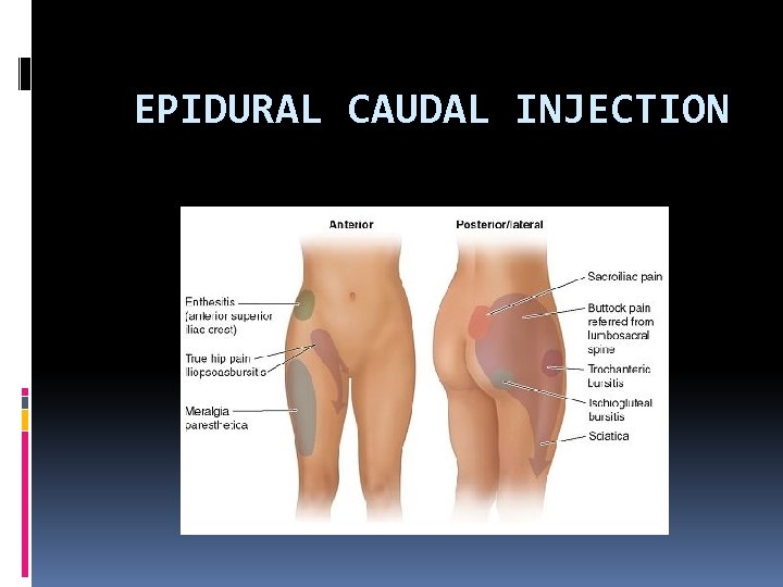 EPIDURAL CAUDAL INJECTION 