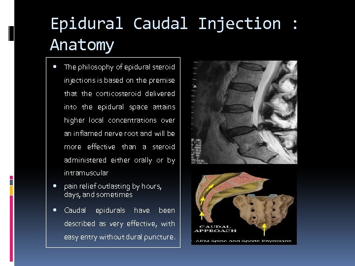 Epidural Caudal Injection : Anatomy The philosophy of epidural steroid injections is based on