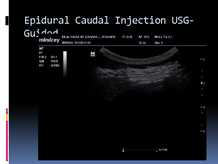 Epidural Caudal Injection USGGuided 