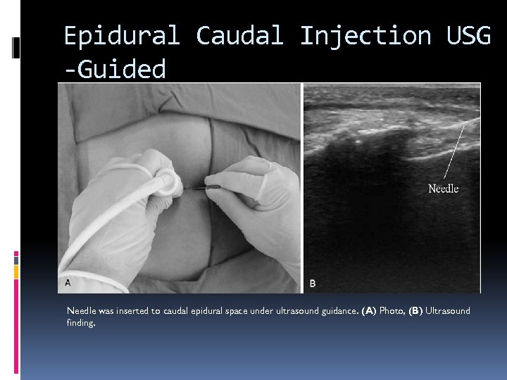 Epidural Caudal Injection USG -Guided Needle was inserted to caudal epidural space under ultrasound