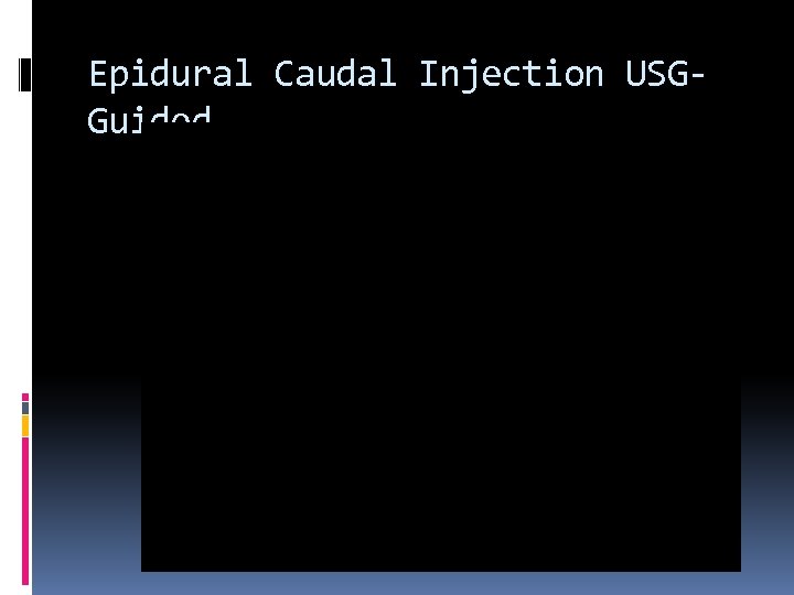 Epidural Caudal Injection USGGuided 