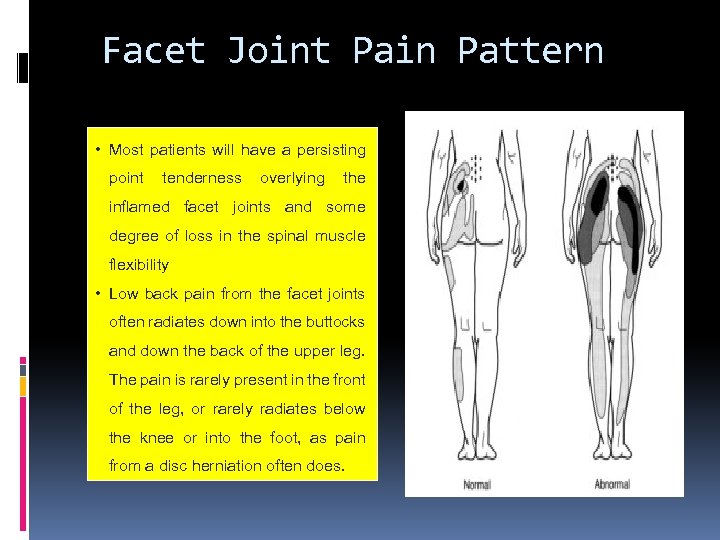 Facet Joint Pain Pattern • Most patients will have a persisting point tenderness overlying