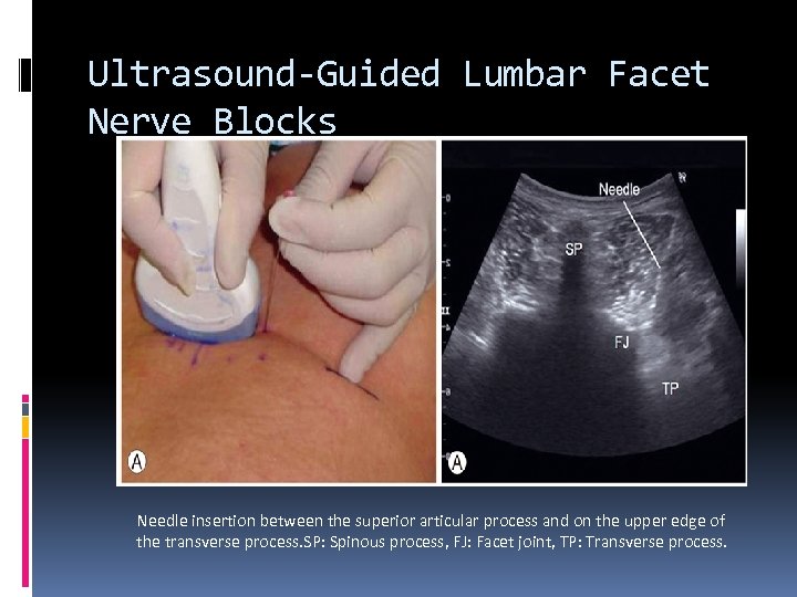 Ultrasound-Guided Lumbar Facet Nerve Blocks Needle insertion between the superior articular process and on
