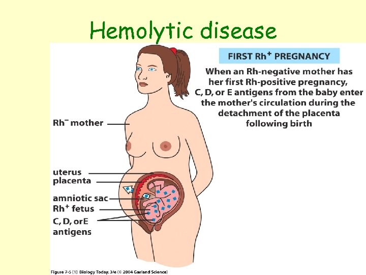 Hemolytic disease Figure 7. 5 (1) 